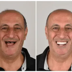 🦷 Denturelix™ Custom-Fit Functional Dentures 😁 Smile with Confidence