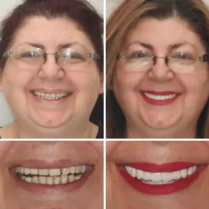 OFFICIAL STORE: Seurico™ - 🦷Advanced Customized Full Denture Set