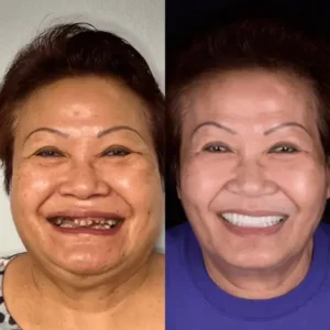 SmileFitPro BioFusion Dentures