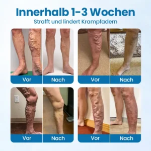 Glowrizon® VeinGuard Herbal Spray – Clinically Proven to Diminish Varicose Veins in Just 7 Days