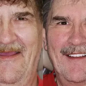 INSIDEEFY™ –🦷Advanced Customized Full Denture Set🦷 {Developed by Harvard University}