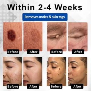 RICPIND® DermaLite Mole and Wart Removal Laser Pen