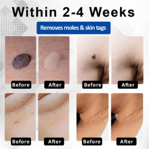 RICPIND® DermaLite Mole and Wart Removal Laser Pen