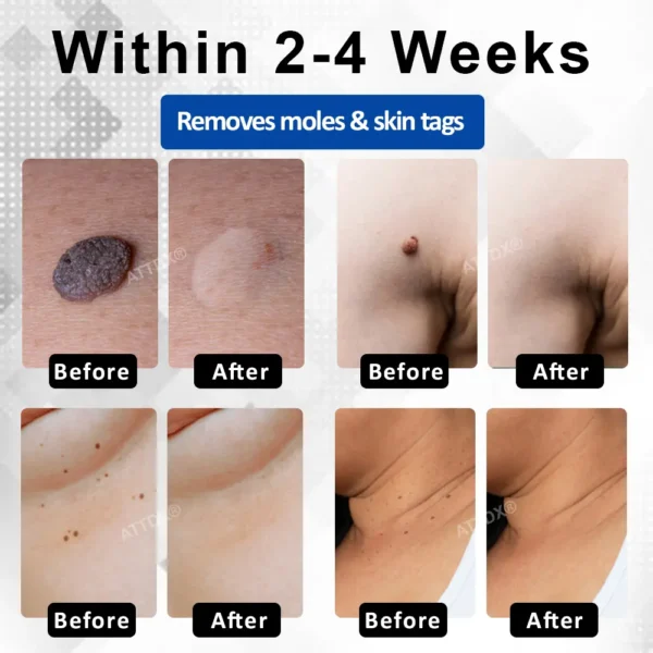 RICPIND® DermaLite Mole and Wart Removal Laser Pen