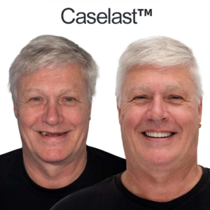 CASELAST™ AdaptableFit Functional Dentures
