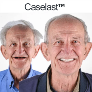 CASELAST™ AdaptableFit Functional Dentures