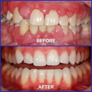 ❤️Rolimey® VioGloss Bienengift-Zahntherapie Oral Power 🦷 (🇩🇪 BZÄK Zugelassen)