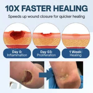 Cvreoz® Ulcer-Relief Diabetes Treatment Cream