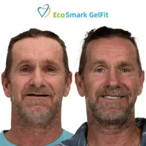 EcoSmark GelFit Dentures