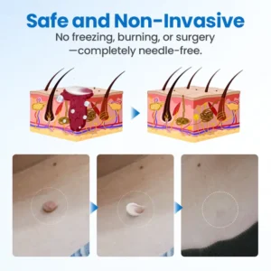 LOVILDS™ TagGone Wart Removal Cream