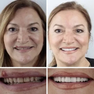 Ends Today: 70% OFF! ⏰70% OFF! FOMONEST™ Medical Full Denture with Strong Suctiond Custom-Fit Full Functional Dentures