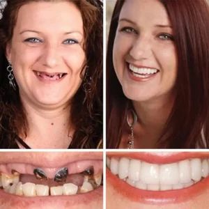 🌎Ends Today: 70% OFF! ⏰ Medical Full Denture with Strong Suctiond