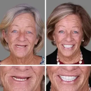 Custom-Fit Full Denture 2026 | Strong Suction Moldable Denture Set