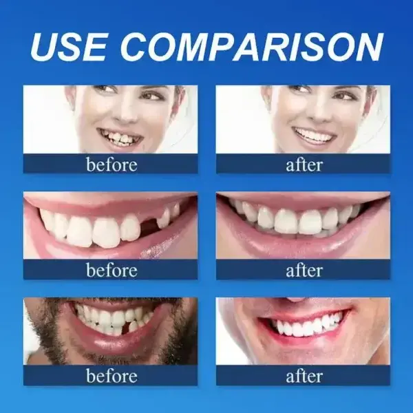 Custom-Fit Full Denture 2026 | Strong Suction Moldable Denture Set