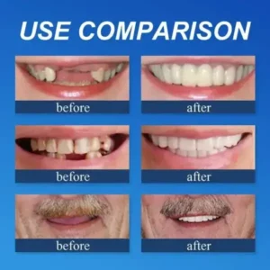Custom-Fit Full Denture 2026 | Strong Suction Moldable Denture Set