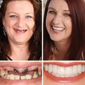 Custom-Fit Full Denture 2026 | Strong Suction Moldable Denture Set