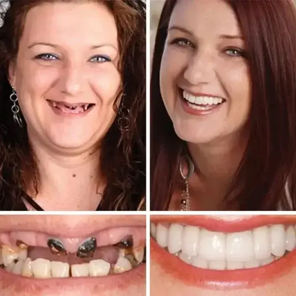 Custom-Fit Full Denture 2026 | Strong Suction Moldable Denture Set