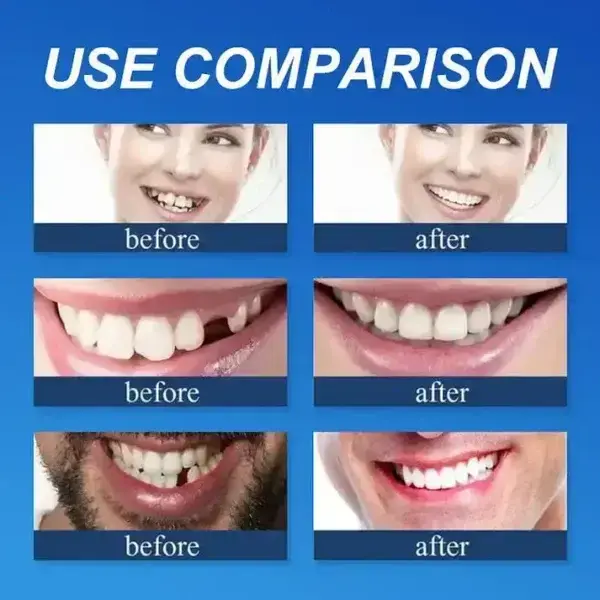 🏆Ends Today: 70% OFF! 🏆2026 Bestselling Product🦷 Fit for a Fresh Smile, Say Goodbye to Wearing Discomfort!🌎