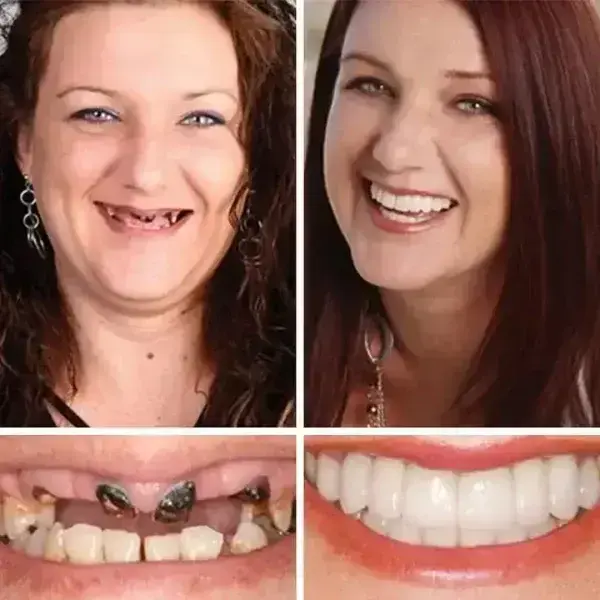 -Ends Today: 70% OFF! ⏰HazyGalaxy™ Medical Full Denture with Strong Suctiond Custom-Fit Full Functional Dentures🦷