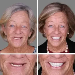 –Ends Today: 75% OFF! ⏰DarkFairy™ Medical Full Denture with Strong Suctiond Custom-Fit Full Functional Dentures🦷